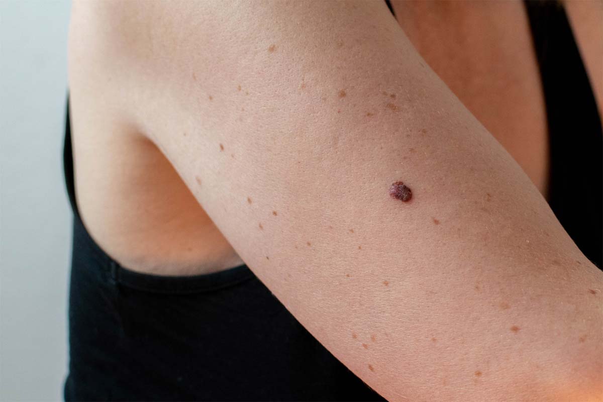 affordable mole removal sunnyvale california