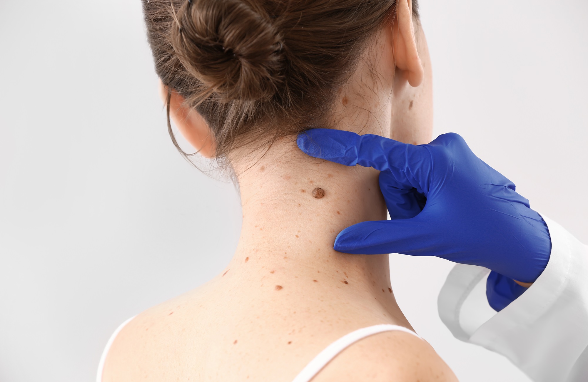 expert mole removal santa clara california