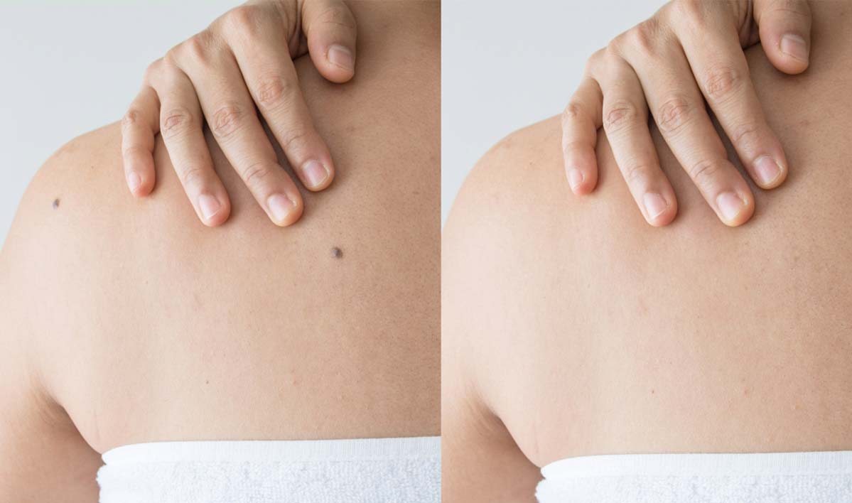 specialized mole removal sunnyvale california