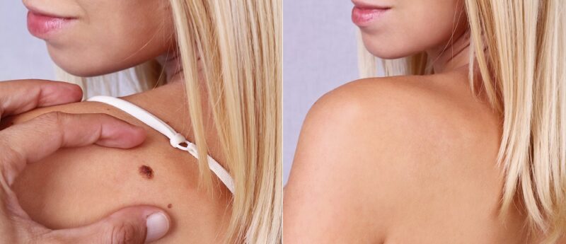 mole removal san mateo california before and after