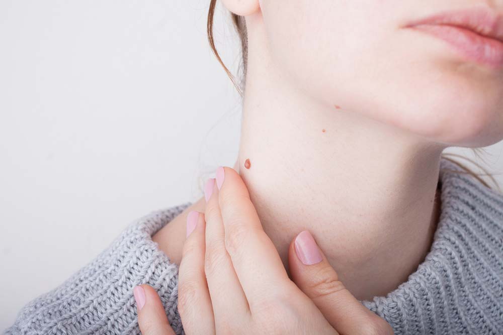neck mole removal san mateo