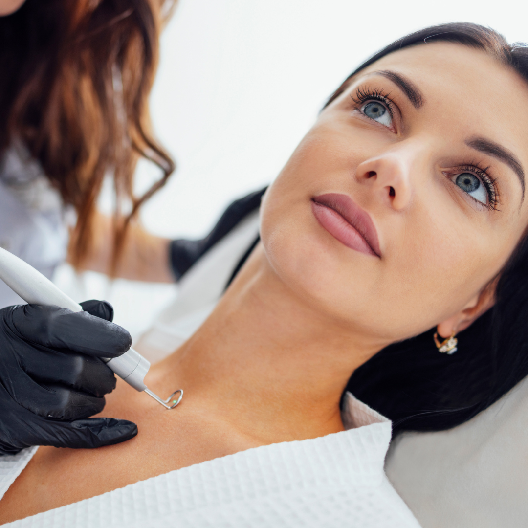 Erbium Laser Mole Removal