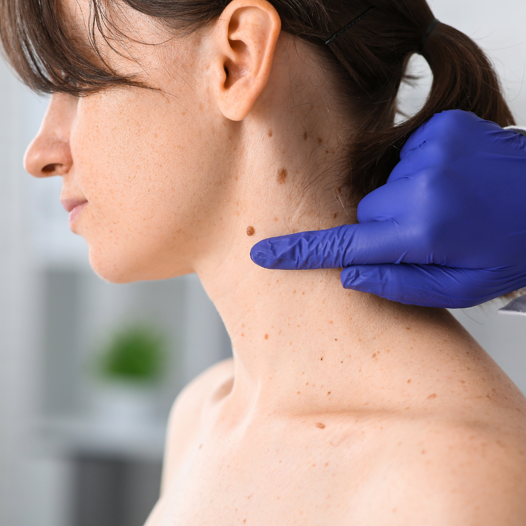 radiofrequency mole removal san francisco