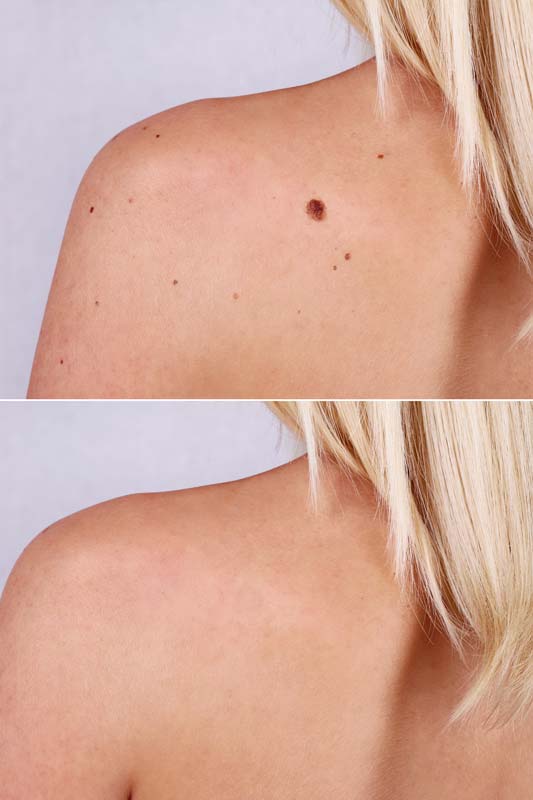 expert mole removal santa rosa california