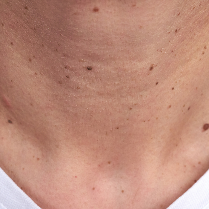 top rated mole removal Marin County