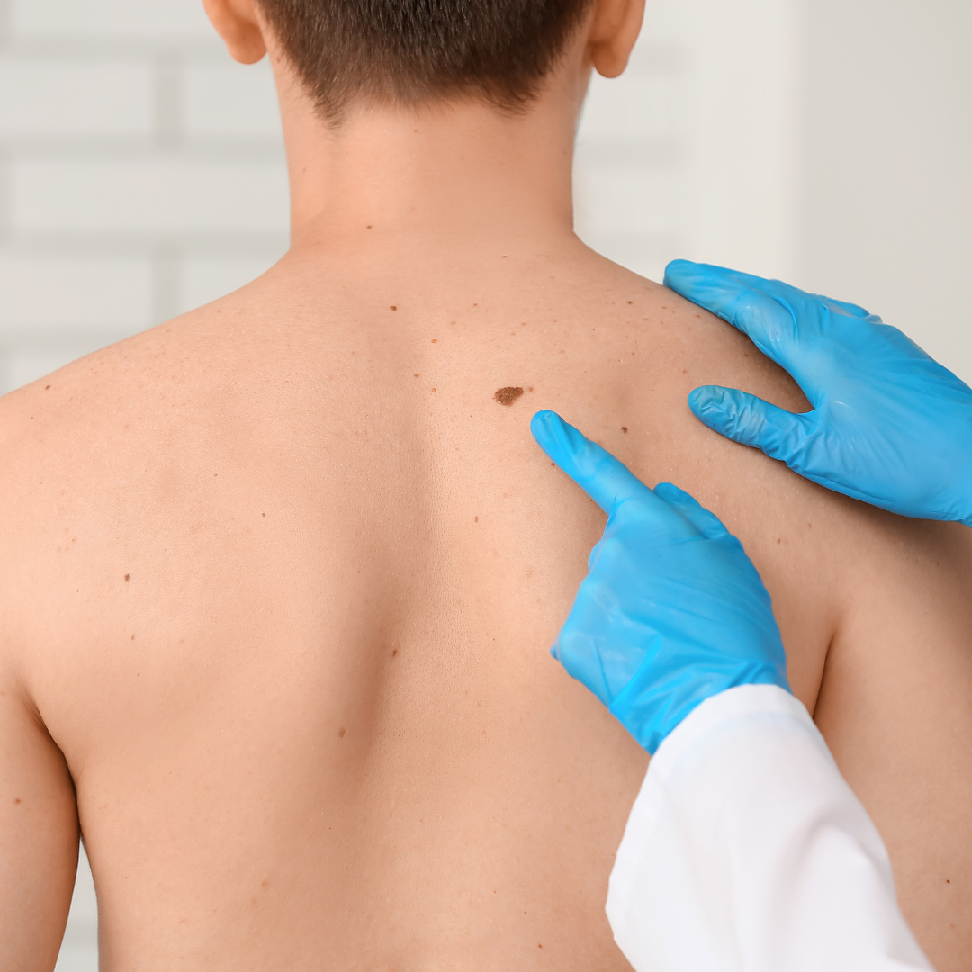 scarfree mole removal Palo Alto California