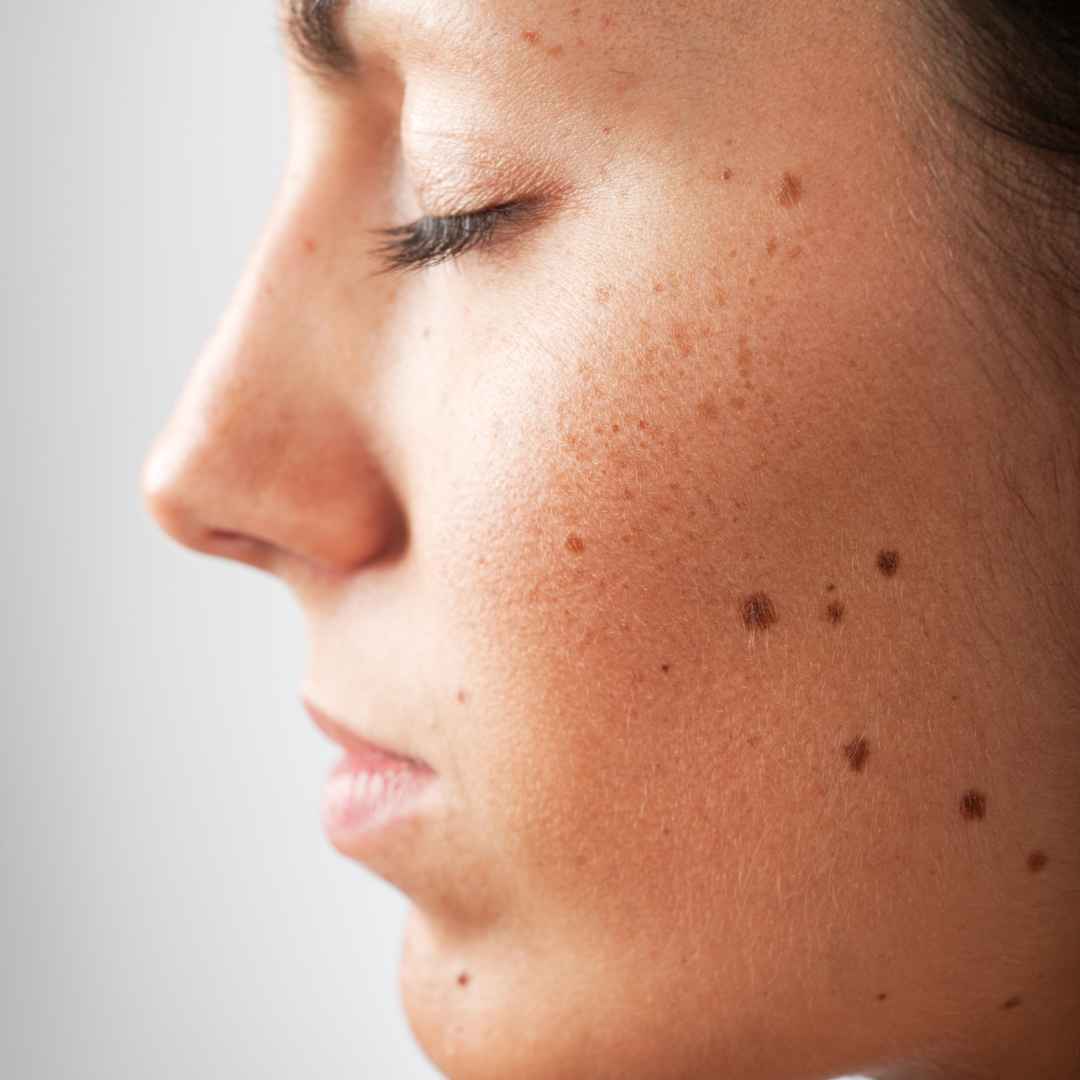 professional mole removal stanford california