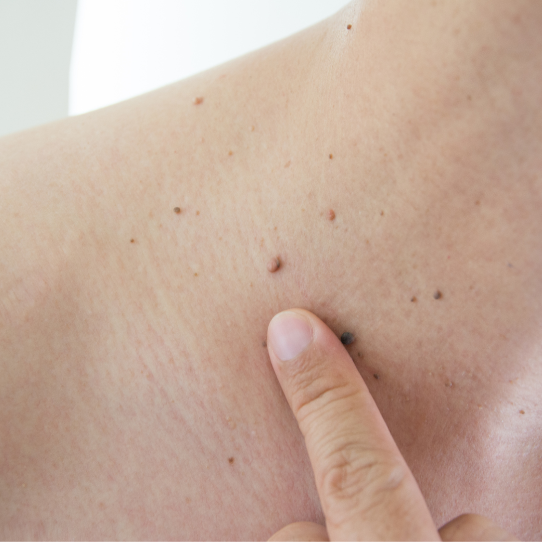 dangers of diy mole removal