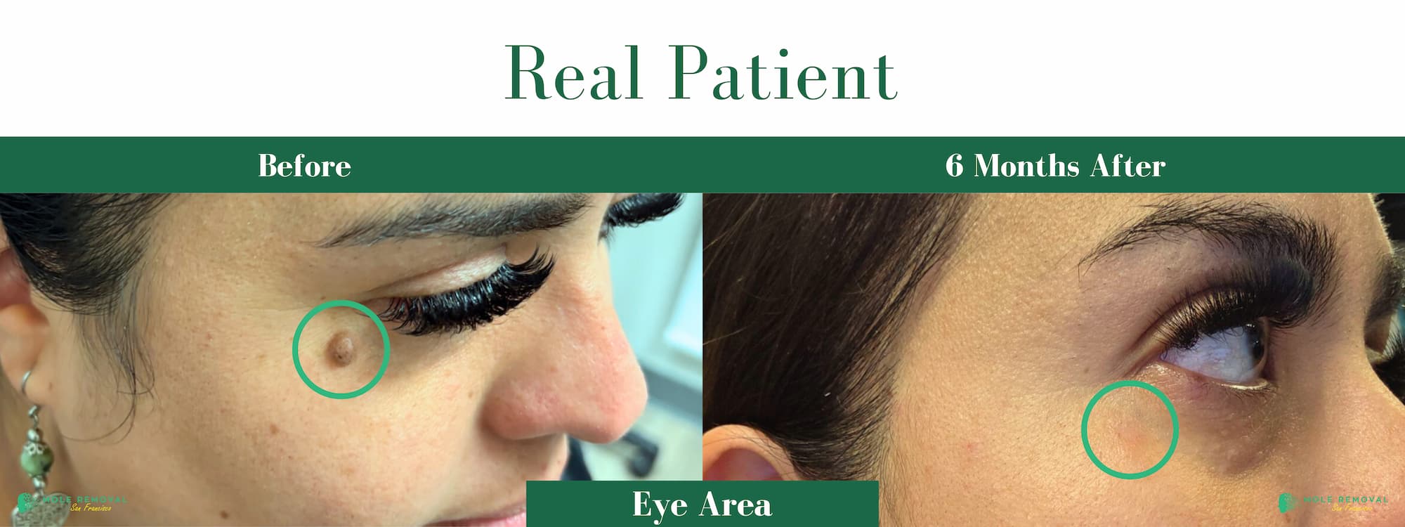 #10 SF Before After Pic expert mole removal san Francisco