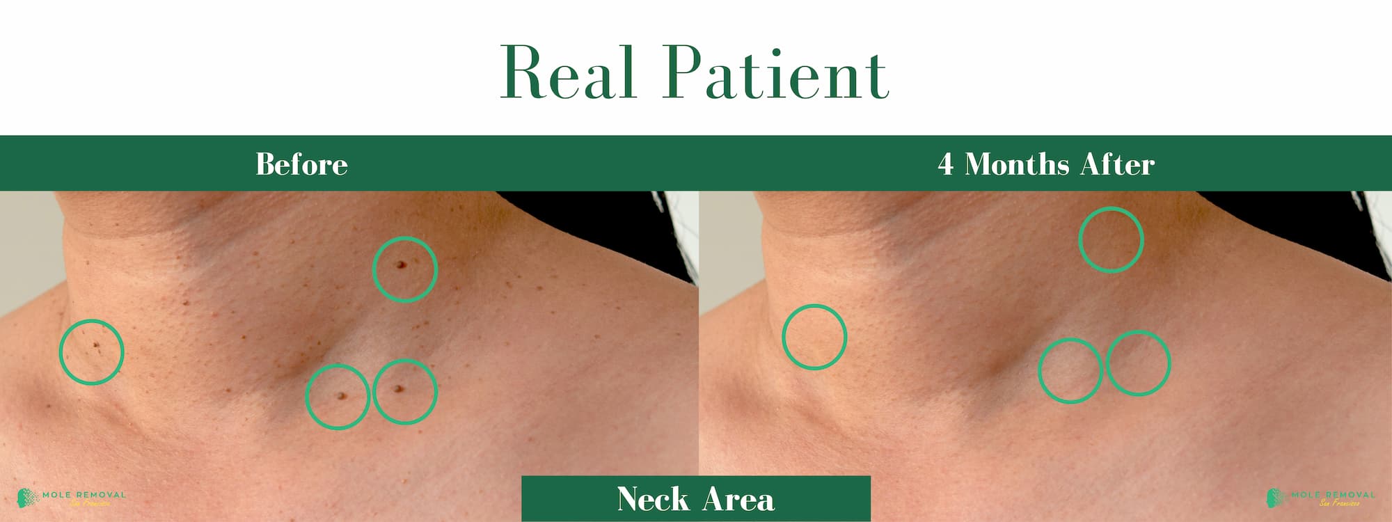 #2 SF Before After Pic expert mole removal san Francisco