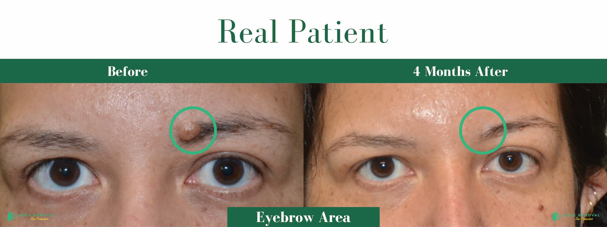 #4 SF Before After Pic expert mole removal san Francisco