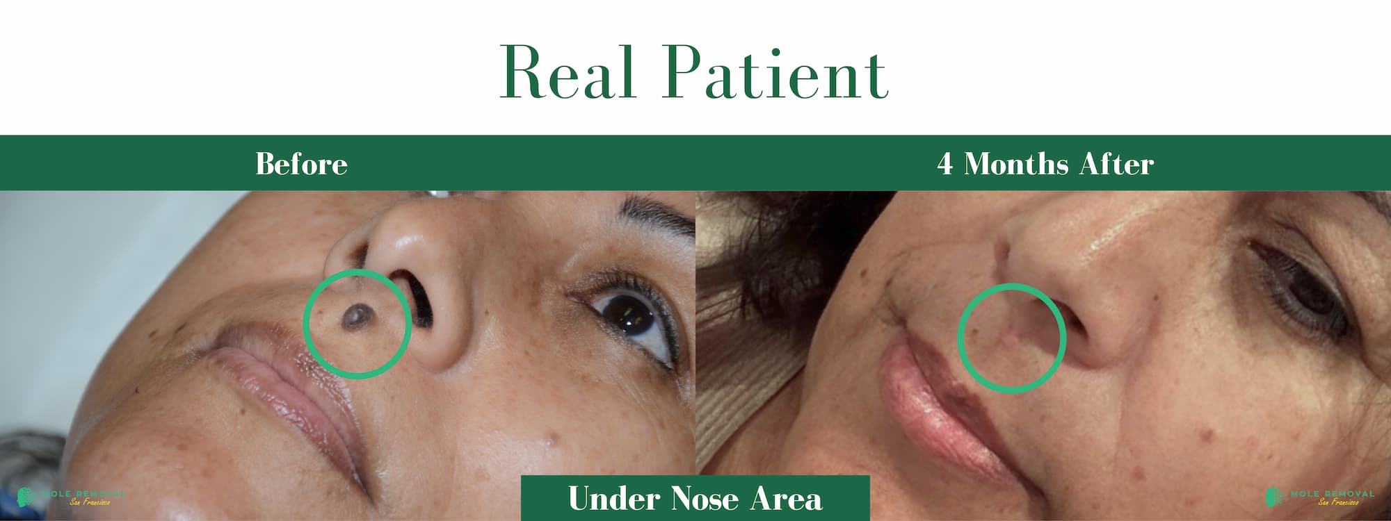 #7 SF Before After Pic expert mole removal san Francisco